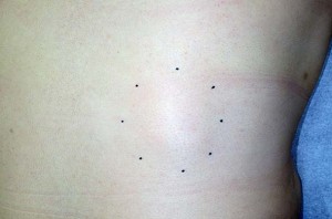 本当の脂肪のかたまり 皮下のできもの 脂肪腫 しぼうしゅ リポーマ 東京 日本橋 銀座エリアの皮膚科 美容皮膚科なら池本形成外科 美容外科