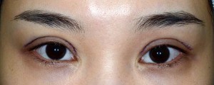 幅が広すぎる二重手術 のため生じた 不自然な三重 の修正手術 東京 日本橋 銀座エリアの皮膚科 美容皮膚科なら池本形成外科 美容外科