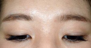 当院での眼瞼下垂切開二重手術 挙筋操作の効用 東京 日本橋 銀座エリアの皮膚科 美容皮膚科なら池本形成外科 美容外科