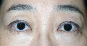 クオリティの低さに驚かされる 眼瞼下垂切開二重の開きすぎ 開かな過ぎ 東京 日本橋 銀座エリアの皮膚科 美容皮膚科なら池本形成外科 美容外科